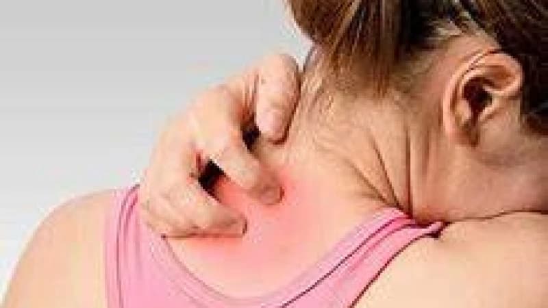 গরমে ঘামাচি থেকে মুক্তি