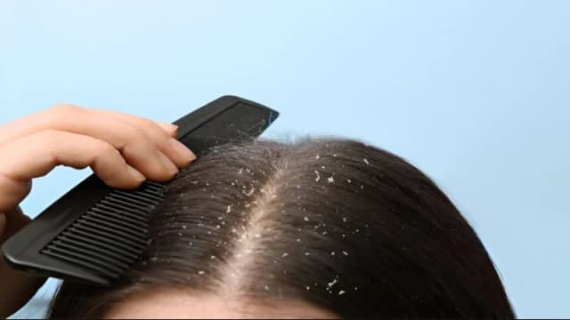 সারা বছর খুশকির সমস্যা? জেনে নিন...