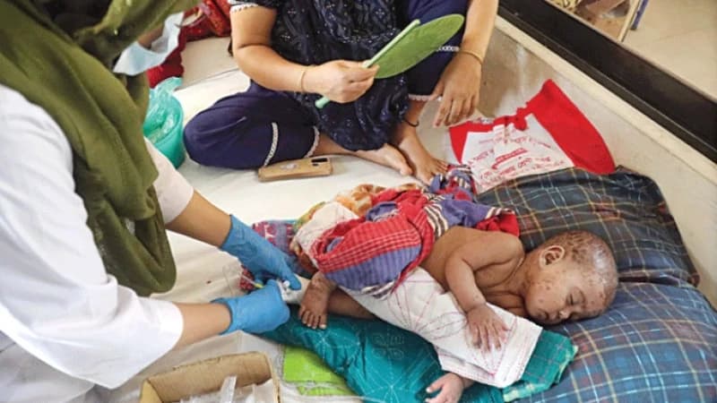 ঊর্ধ্বমুখী হামের সংক্রমণ, বাড়ছে মৃত্যু