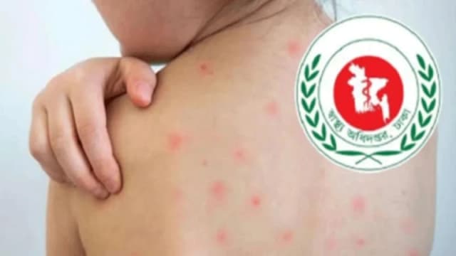হাম উপসর্গে প্রাণ গেল আরও ৬ শিশুর
