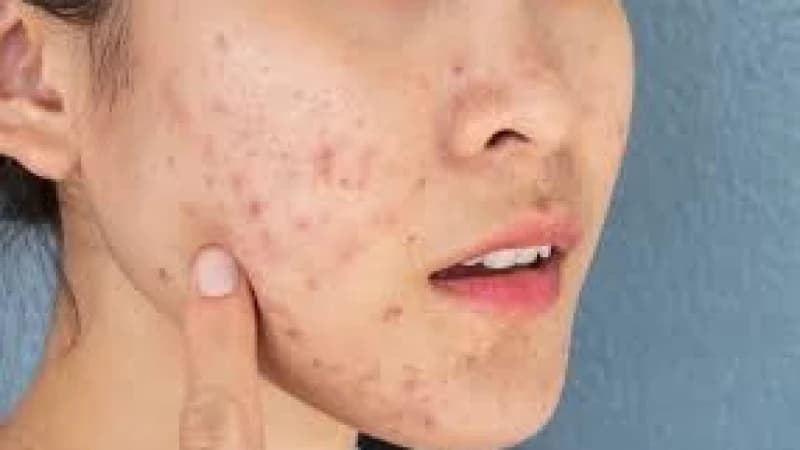ব্রণের দাগ কমাতে প্রাকৃতিক তিন উ...