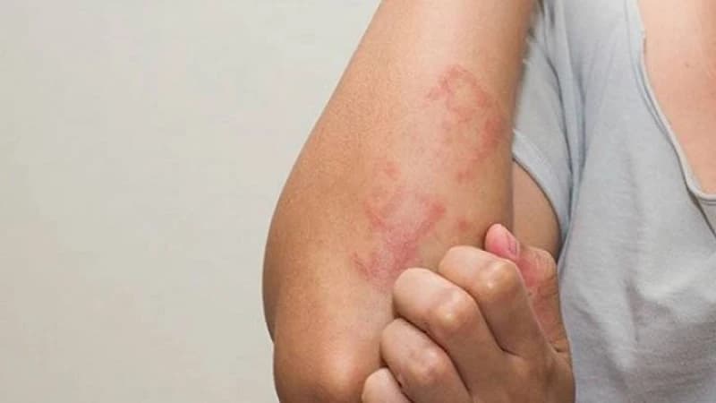 ছারপোকার ফলে কি কি শারীরিক সমস্যা হতে পারে
