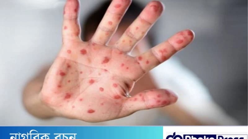 ইউরোপে হামের প্রাদুর্ভাব বেড়েছে ৪৫ গুণঃ ডব্লিউএইচও