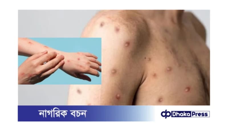 মাঙ্কিপক্স: সতর্ক থাকুন এই মারণ রোগ থেকে মাঙ্কিপক্স: সতর্ক থাকুন এই মারণ রোগ থেকে