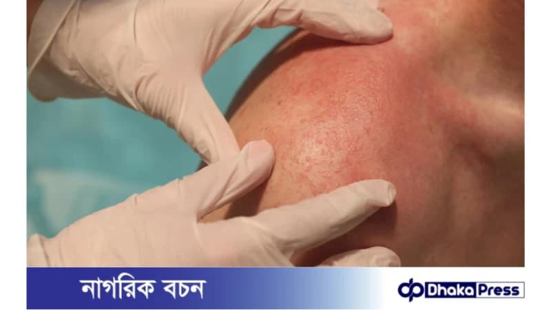 সান অ্যালার্জি এড়ানোর উপায় সান অ্যালার্জি এড়ানোর উপায়