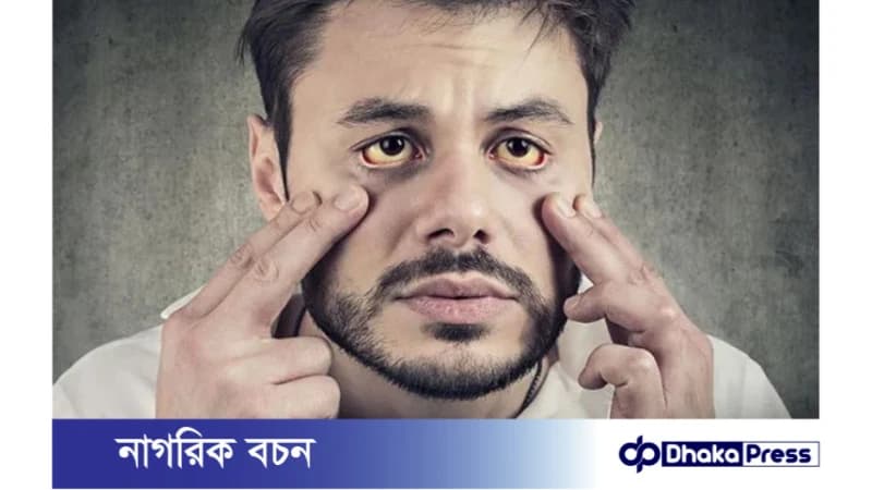 তীব্র গরমের বাড়ে জন্ডিসের উপসর্গ তীব্র গরমের বাড়ে জন্ডিসের উপসর্গ