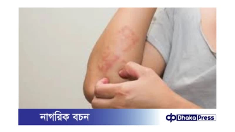 বর্ষায় চর্মরোগ বৃদ্ধির কারণ: বর্ষায় চর্মরোগ বৃদ্ধির কারণ: